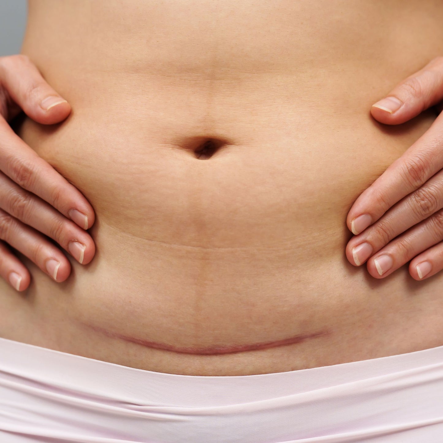Scar Tissue (Including C-Section Scar)