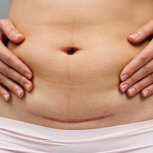 Scar Tissue (Including C-Section Scar)